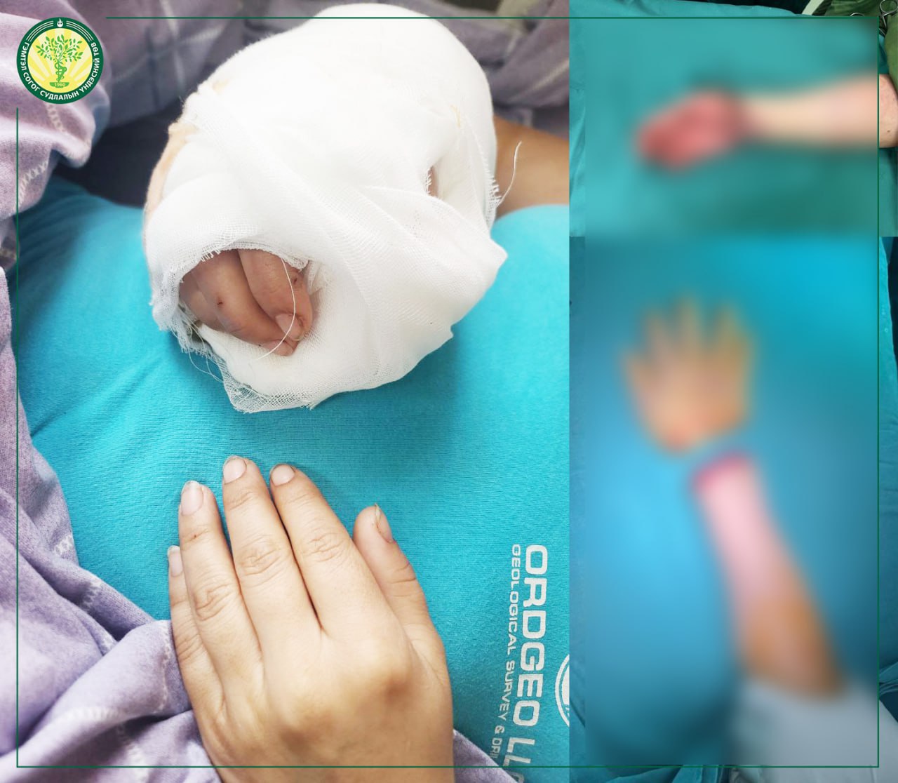 ГССҮТ-ИЙН ЭМЧ НАР БҮРЭН ТАСАРСАН МӨЧИЙГ ЭРГҮҮЛЭН ЗАЛГАХ 200 ДАХЬ МЭС ЗАСЛАА АМЖИЛТТАЙ ХИЙЛЭЭ
