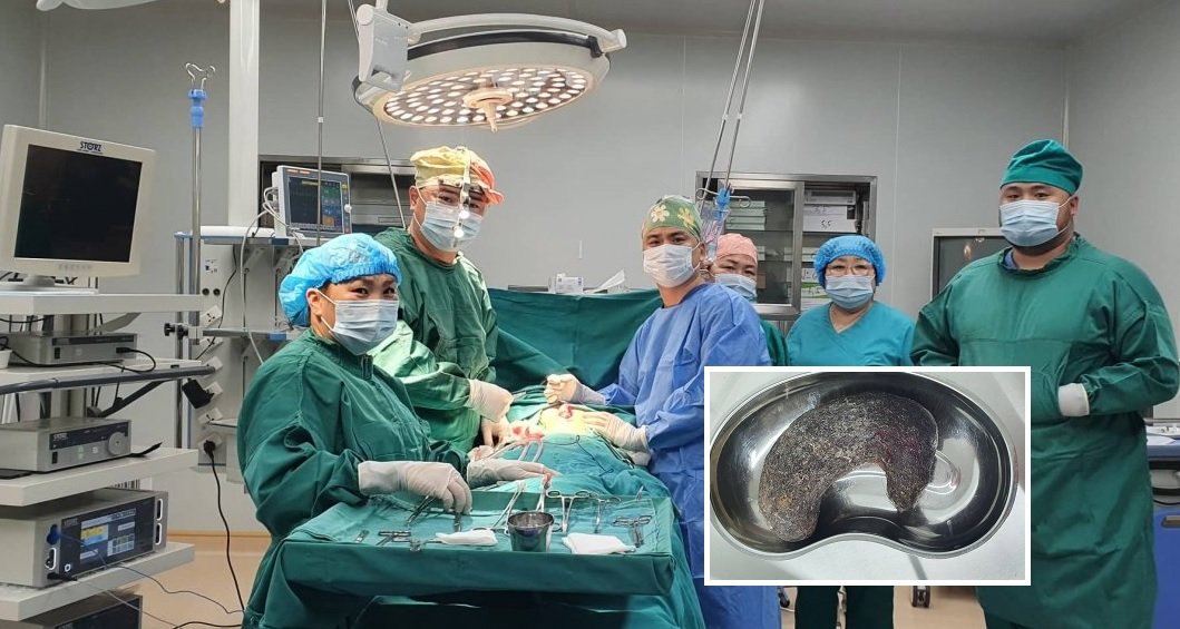 Дорнод аймгийн БОЭТ-ийн мэс заслын эмч нар 6 настай хүүхдийн ходоодноос гадны биет авах МЭС ЗАСЛЫГ амжилттай хийжээ